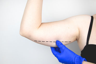 Brachioplasty